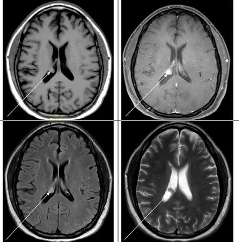 Axial T1 Mri Of The Brain Without A And With B Contrast Flair C