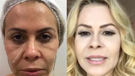 Modelos, atores e apresentadores tiram da sua imagem seu sustento. Joelma impressiona com antes e depois de intervenções no rosto