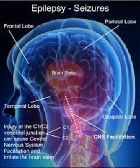Epilepsy Symptoms Causes Types And Treatment Mediologiest
