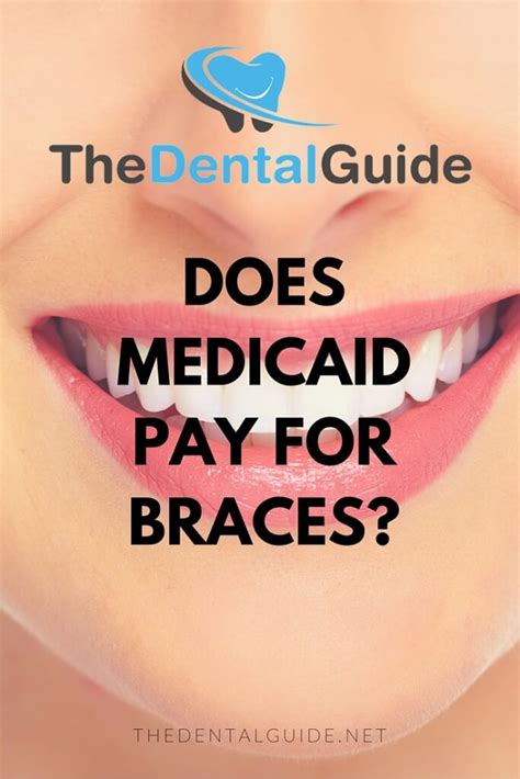This plan may include braces, as well as other types of dental appliances, such as space maintainers and retainers. Does Medicaid Pay For Braces? - The Dental Guide USA