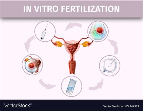 Human In Vitro Fertilization Stages Infographic Vector Image My Xxx