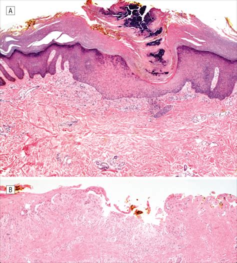 Treatment Of Acquired Perforating Dermatosis With Cantharidin