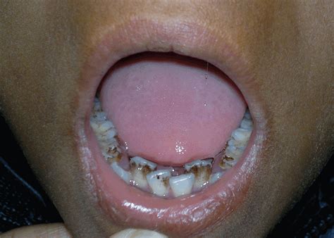 Dermoid Cyst Teeth