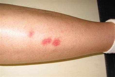 What Do Bed Bug Bites Look Like Readers Digest