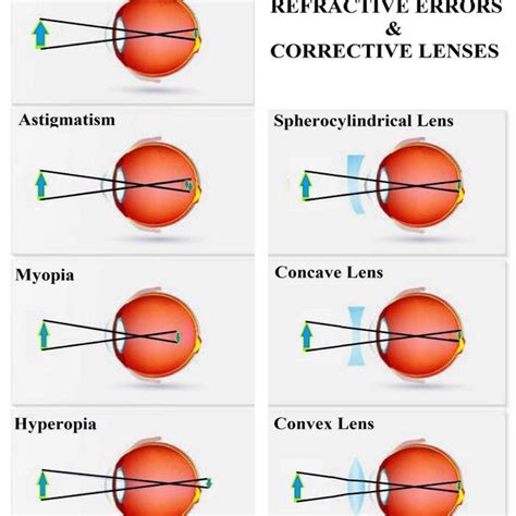 llustrates refractive errors and proper corrective lenses to correct download scientific