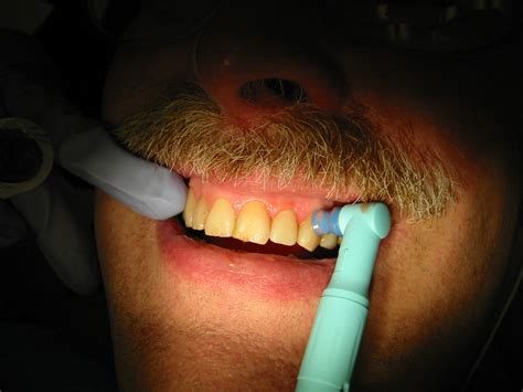 Teeth Cleaning Wikipedia