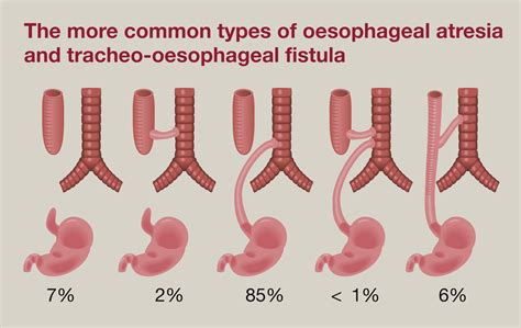 oesophageal atresia and tracheo oesophageal fistula surgery oxford international edition