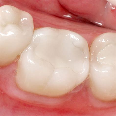 Composite Fillings Zebra Dental Windermere Dentist
