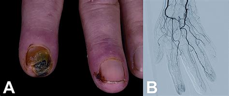Severe Raynauds Phenomenon After Treatment With Interferon Beta For
