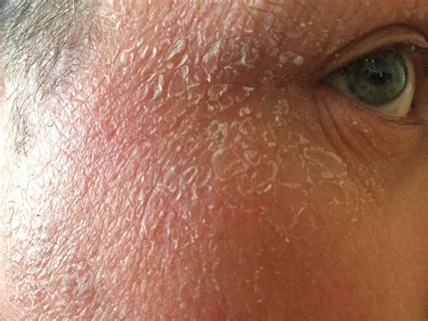 My Pityriasis Rubra Pilaris Blog Dry Face
