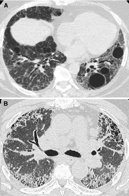 Diffuse Cystic Lung Disease Associated With Interstitial Lung Diseases
