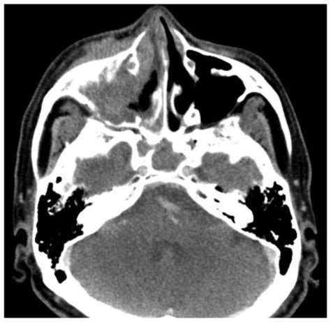 Regression Of Advanced Maxillary Sinus Cancer With Orbital Invasion By
