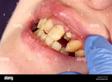 Dental Pin Close Up Preparation Of The Tooth For The Formulation Of