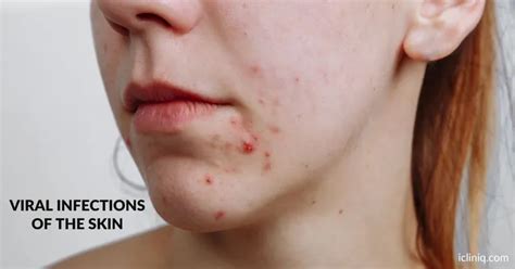 Viral Infections Of The Skin