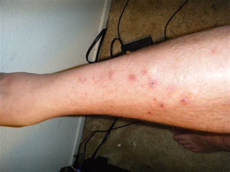 Ringworm On Legs Pictures Photos