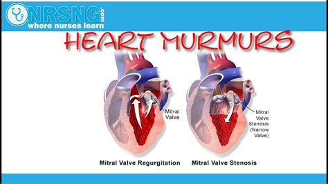 heart murmurs aortic mitral stenosis regurgitation how to identify youtube