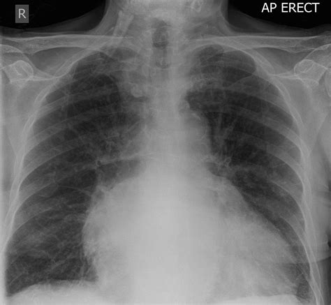 Mitral Stenosis Chest Radiographs May Show Cardiomegaly Double Right