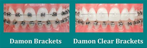 Damon Braces The Latest In Orthodontics