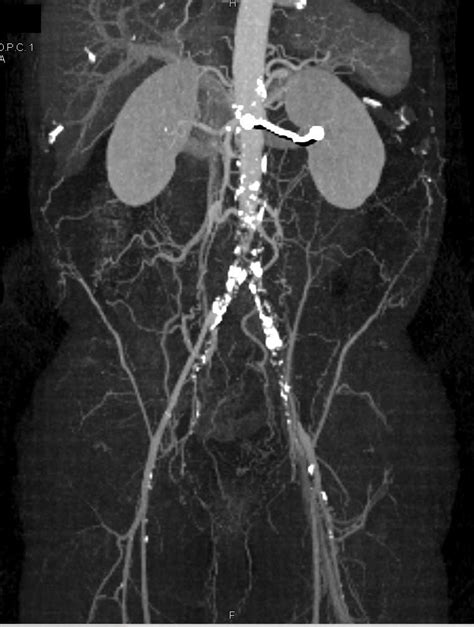 Aortic Occlusion Due To Atherosclerotic Disease With Collaterals