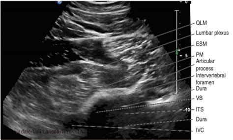 Lumbar Paravertebral Sonography And Considerations For Ultrasound