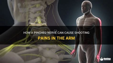 How A Pinched Nerve Can Cause Shooting Pains In The Arm Medshun