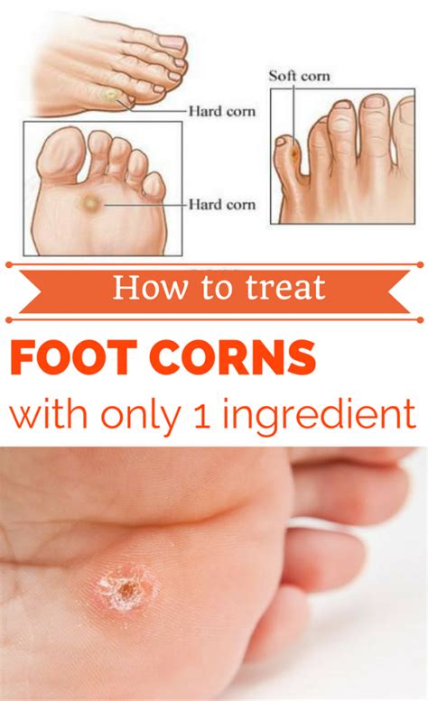 How To Treat Foot Corns With Only 1 Ingredient Get