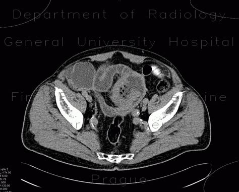 Radiology Case Lymphoma Of Small Bowel Ileum