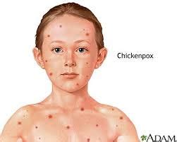 Bagi yang tidak bernasib baik, bila terkena chicken pox semasa kecil, parut di muka kekal sehingga dewasa! Hilangkan Parut Chicken Pox Dalam 7 Hari | Vitamin Cerdik ...