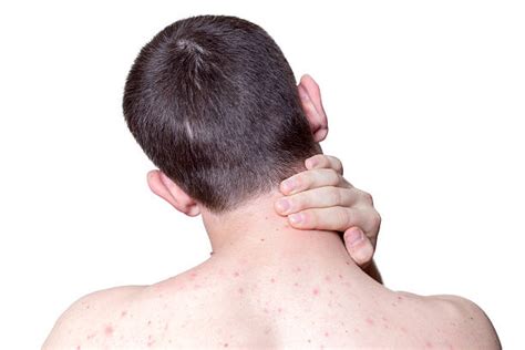 110 Acne On A Males Shoulder Stock Photos Pictures And Royalty Free
