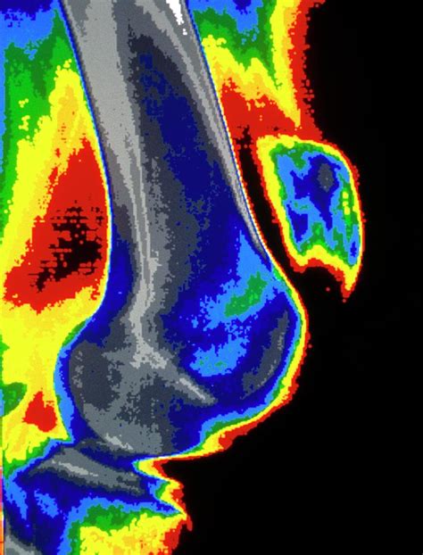 Coloured X Ray Of Dislocated Kneecap Photograph By Gcascience Photo