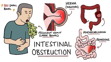 Intestinal Obstruction Small Bowel Obstruction Vs Large Bowel Obstruction Youtube