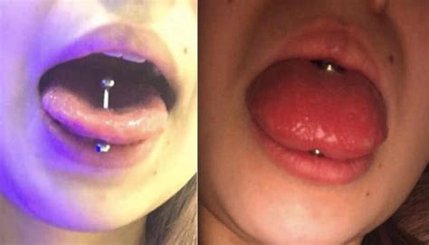 Tongue Piercing Infection