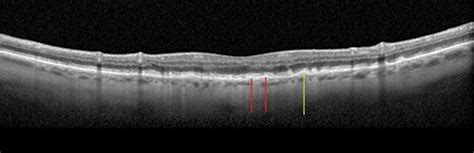 Take Macular Oct To A Whole New Layer