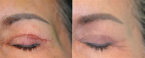 Scar Revision Photos Chevy Chase Md Patient 20263