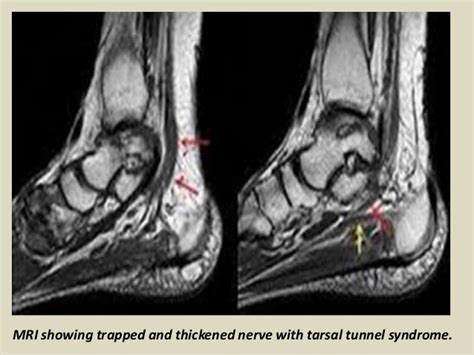 Presentation1 Radiological Imaging Of Tarsal Tunnel Syndrome