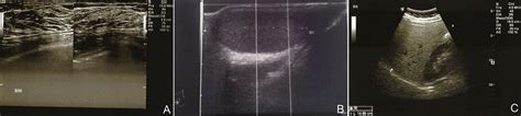 A The Breast Ultrasound Scan Showed Monolateral Gynecomastia