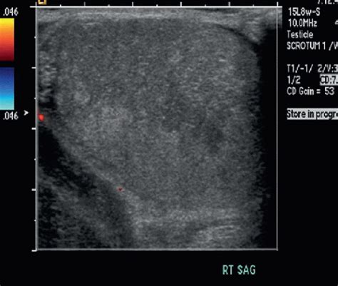 Testicular Torsion Radiology Key