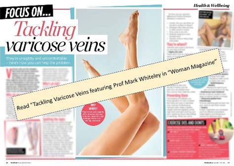 Tackling Varicose Veins Article In Woman Magazine The Whiteley Clinic