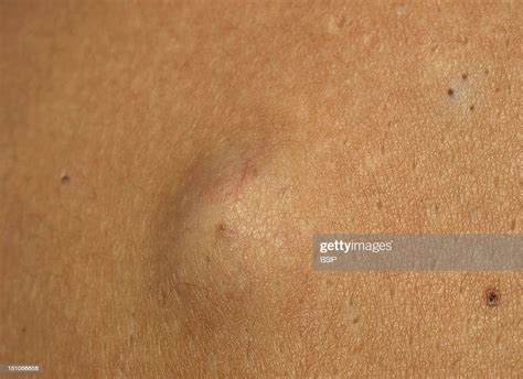 Sebaceous Cyst Of The Shoulder News Photo Getty Images