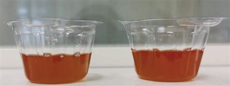 Urine Appearance A Reddish Urine Of The Patient Suffering Acute