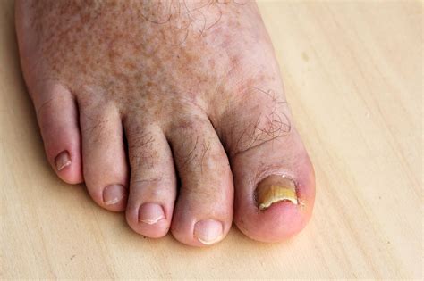 Some signs of an infection are throbbing pain, discharge, and an odor. What are Toe Infection and How to Treat Them! | Marietta ...