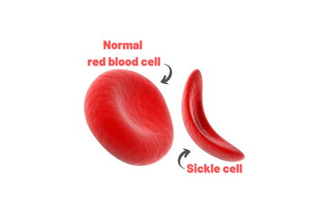 World Sickle Cell Day 2020 What Is Sickle Cell Disease Regency Hospita