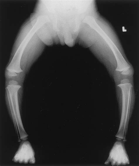 Radiographic Characteristics Of Lower Extremity Bowing In Children