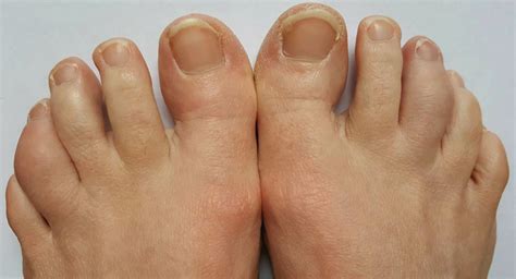 Case Report A Psoriatic Arthritis Patient With Dactylitis And Enthesitis
