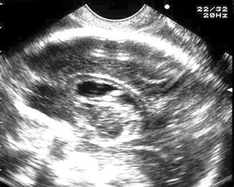 Prenatal Diagnosis Of Absence Of The Septum Pellucidum Associated With
