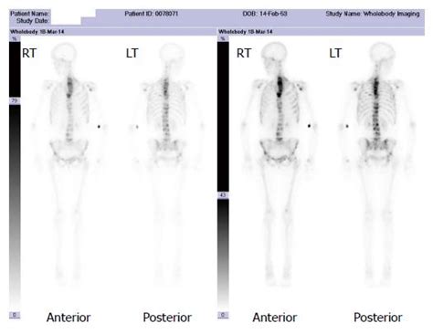 Imaging Of Bone Metastasis An Update
