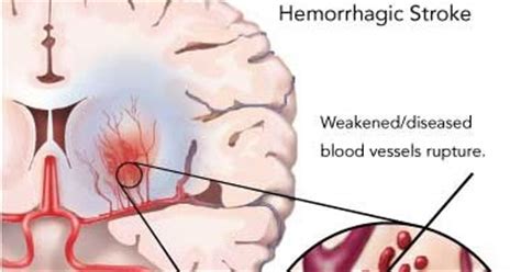 ~10% of all acute strokes. Medical Health Treatment and Therapy : Hemorrhagic Stroke