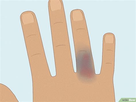 How To Know If Your Knuckle Is Broken Symptoms And More