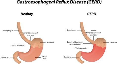 What Is The Difference Between Gerd And Acid Reflux Disease