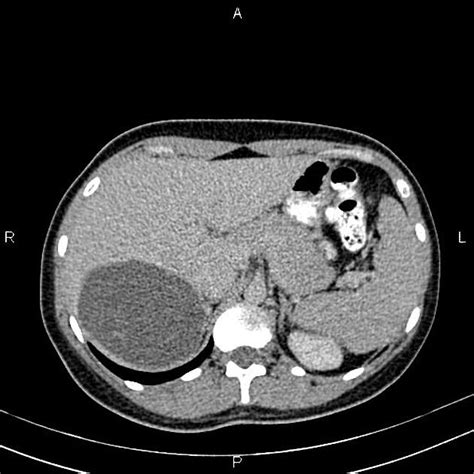 Brown Hospital Medicine On Twitter A 30 Year Old Female Presented For